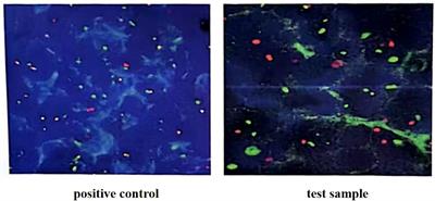 Case report: Sandwich therapy of CAR-T combined with ASCT: Sequential CAR-T cell therapy with ASCT after remission with CAR-T therapy caused long-term survival in a patient with relapsed/refractory Burkitt’s lymphoma with TP53 mutations